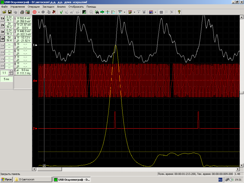 ВМТ и 20й зуб..PNG